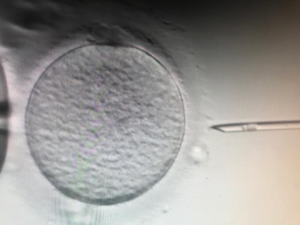 UN ALTRA POSSIBILITÀ PER LA STERILITÀ MASCHILE: Fecondare gli ovociti con spermatidi rotondi: ROSI modificata